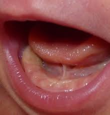 Formación Universitaria de Especialización en Anquiloglosia pediátrica
